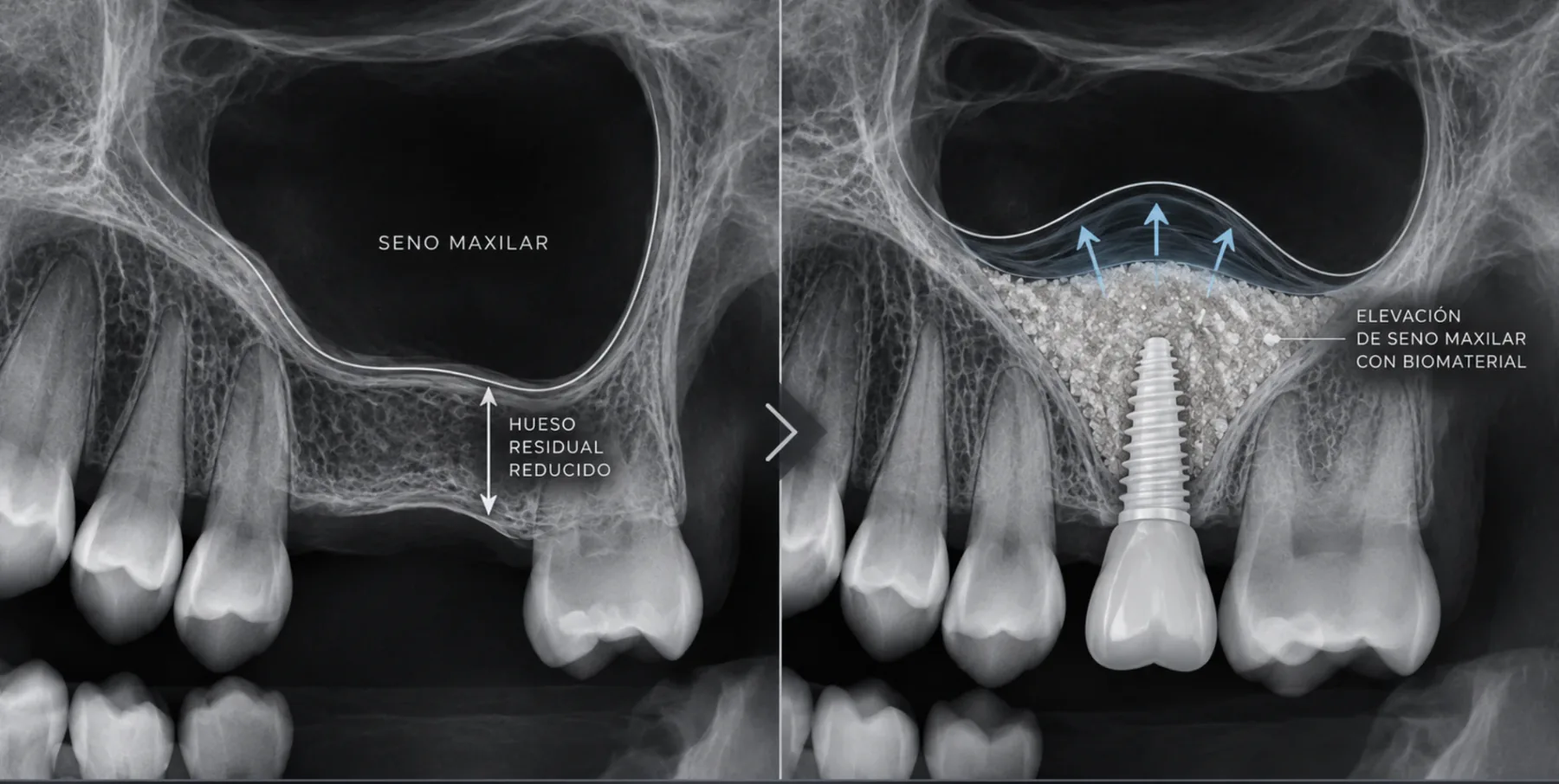 Comparativa radiográfica de una elevación de seno maxilar: hueso residual reducido y seno elevado con biomaterial